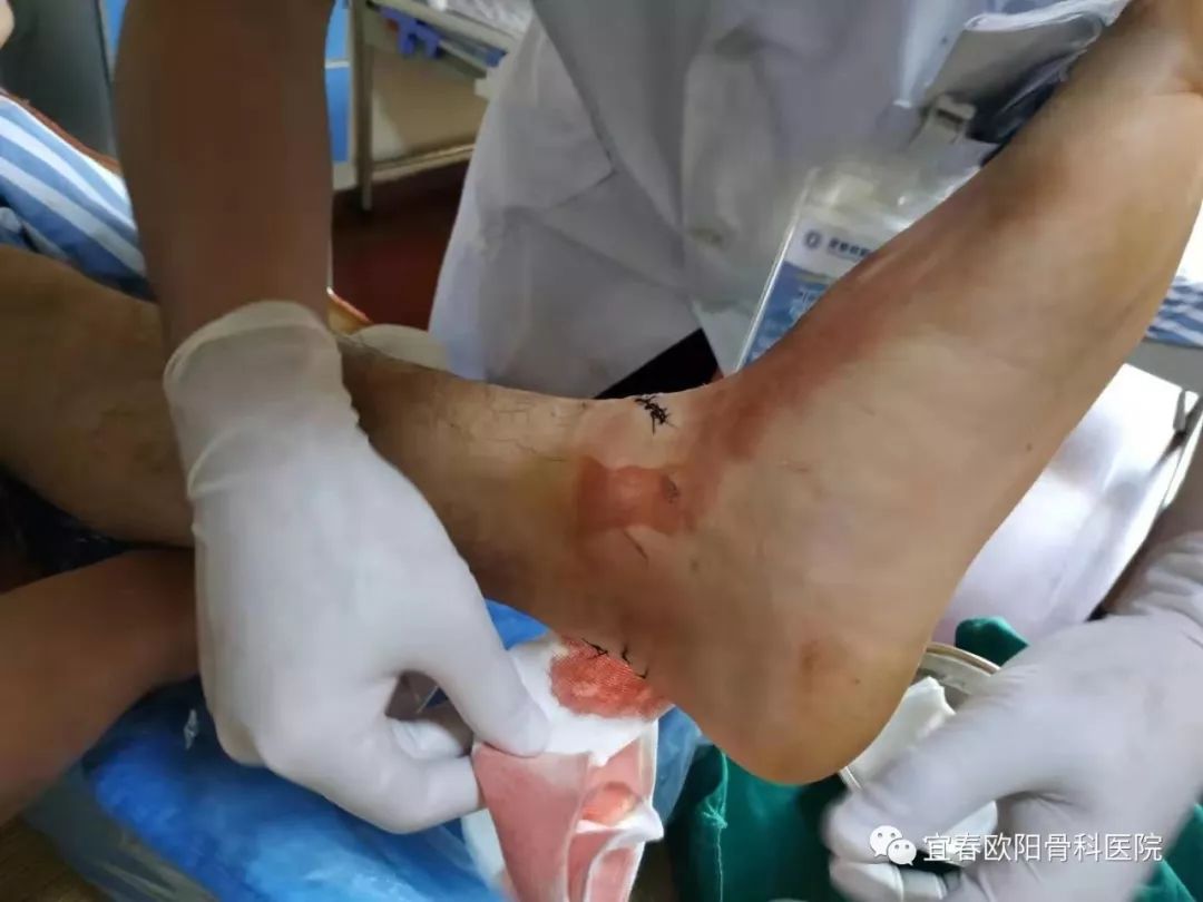 少年腳跟被玻璃割裂，手足外科醫(yī)師緊急手術(shù)