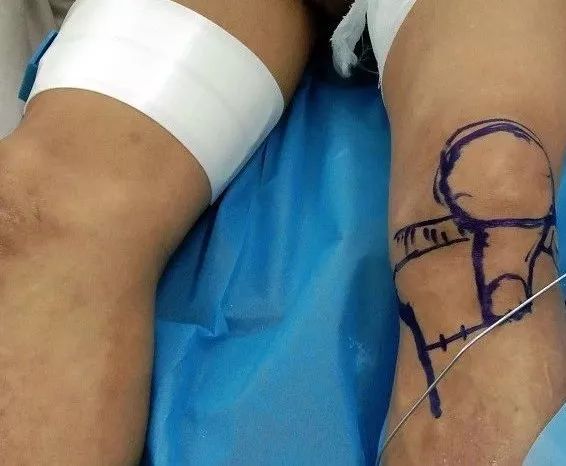我院保膝治療又獲成功，關(guān)節(jié)病患者的福音！