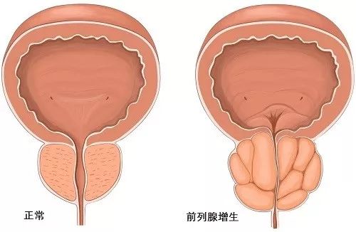 前列腺增生，尿頻、尿急怎么辦？等離子電切術(shù)治愈！